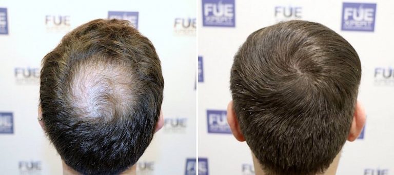 Antes y Después - 1850 Injertos- Trasplante capilar FUE - Dr Juan Couto en clínica capilar FUExpert Clinic - Madrid, España