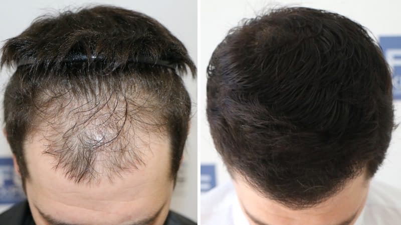 Antes y Después - 2500 Injertos - Trasplante capilar FUE - Dr Juan Couto - FUExpert Clinic - Madrid, España