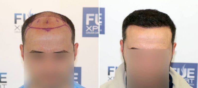 Antes y Después - 3601 Injertos- Trasplante capilar FUE - Dr Juan Couto en clínica capilar FUExpert Clinic - Madrid, España