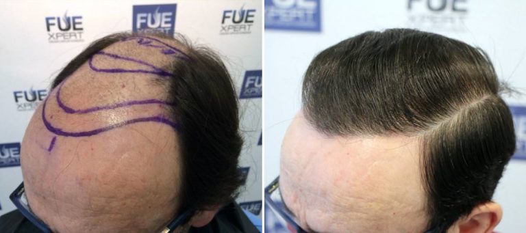 Antes y Después - 3652 Injertos- Trasplante capilar FUE - Dr Juan Couto en clínica capilar FUExpert Clinic - Madrid, España