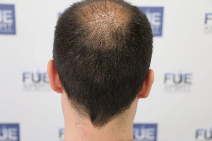 640-Injertos-Reparación-capilar-FUE-cicatrices-Dr-Couto-FUExpert-Clinic-10