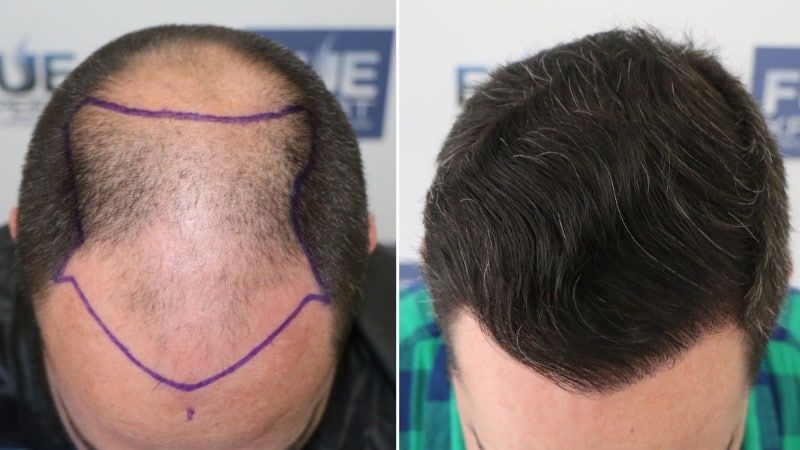 Antes Después 4766 Injertos FUE - Trasplante Capilar FUE por el Dr Juan Couto en FUExpert Clinic - Clínica Capilar en Madrid, España