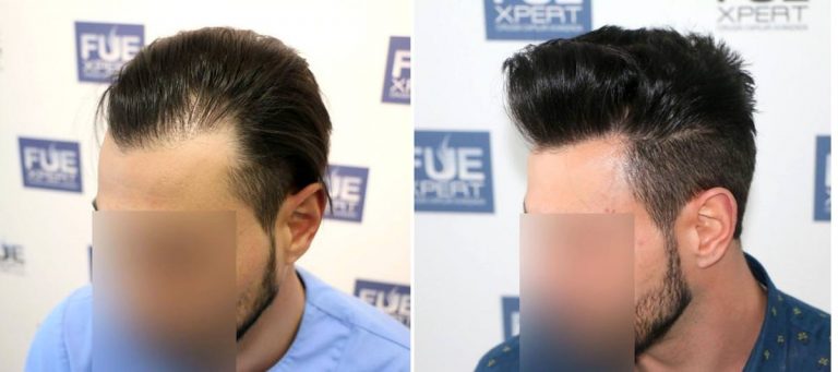 Antes y Después 1200 Injertos- Trasplante capilar FUE - Dr Juan Couto en clínica capilar FUExpert Clinic - Madrid, España