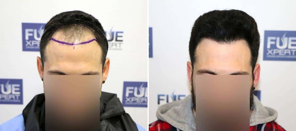 Antes y Después - 1800 Injertos- Trasplante capilar FUE - Dr Juan Couto en clínica capilar FUExpert Clinic - Madrid, España