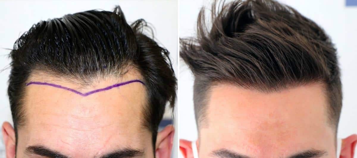 Antes y Después 2000 Injertos- Trasplante capilar FUE - Dr Juan Couto en clínica capilar FUExpert Clinic - Madrid, España