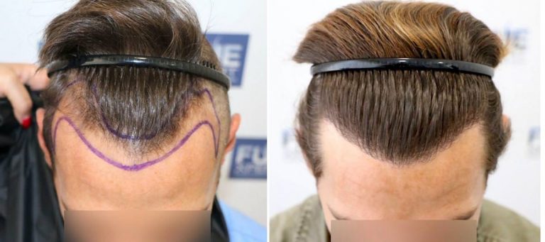 Antes y Después 2050 Injertos- Trasplante capilar FUE - Dr Juan Couto en clínica capilar FUExpert Clinic - Madrid, España