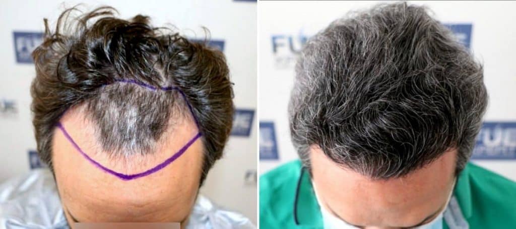 Antes y Después 2073 Injertos- Trasplante capilar FUE - Dr Juan Couto en clínica capilar FUExpert Clinic - Madrid, España