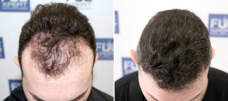 Antes y Después 2088 Injertos- Trasplante capilar FUE - Dr Juan Couto en clínica capilar FUExpert Clinic - Madrid, España