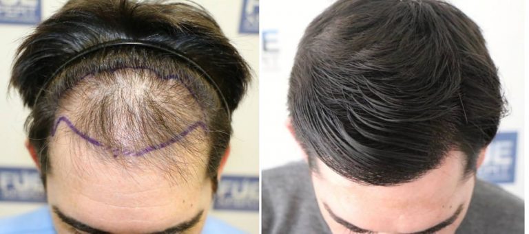 Antes y Después 2208 Injertos- Trasplante capilar FUE - Dr Juan Couto en clínica capilar FUExpert Clinic - Madrid, España