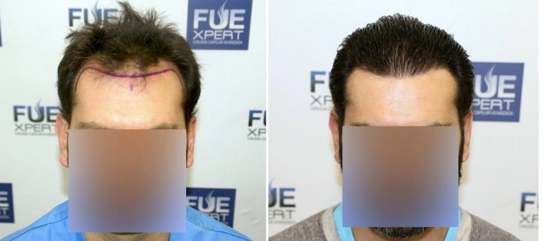 Antes y Después - 2704 Injertos- Trasplante capilar FUE - Dr Juan Couto en clínica capilar FUExpert Clinic - Madrid, España
