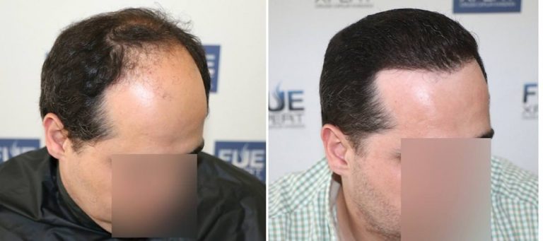 Antes y Después 3000 Injertos- Trasplante capilar FUE - Dr Juan Couto en clínica capilar FUExpert Clinic - Madrid, España