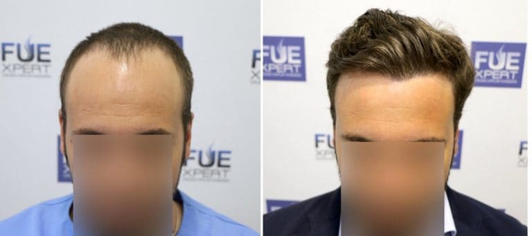 Antes y Después 3054 Injertos- Trasplante capilar FUE - Dr Juan Couto en clínica capilar FUExpert Clinic - Madrid, España