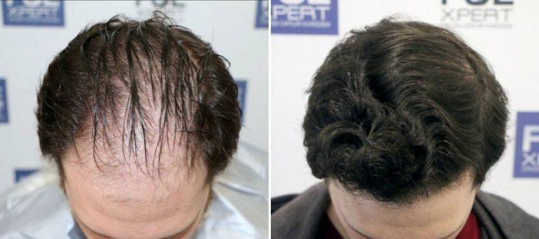 Antes y Después 3057 Injertos- Trasplante capilar FUE - Dr Juan Couto en clínica capilar FUExpert Clinic - Madrid, España