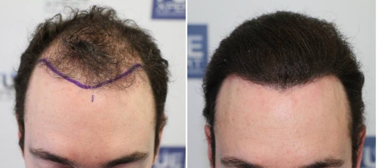 Antes y Después 3070 Injertos- Trasplante capilar FUE - Dr Juan Couto en clínica capilar FUExpert Clinic - Madrid, España