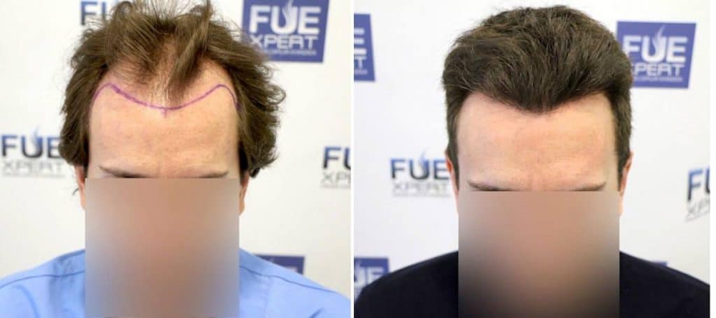 Antes y Después 3251 Injertos- Trasplante capilar FUE - Dr Juan Couto en clínica capilar FUExpert Clinic - Madrid, España
