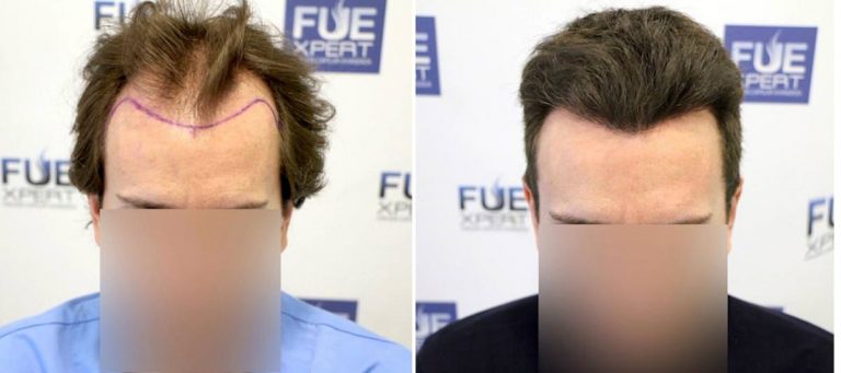 Antes y Después 3251 Injertos- Trasplante capilar FUE - Dr Juan Couto en clínica capilar FUExpert Clinic - Madrid, España