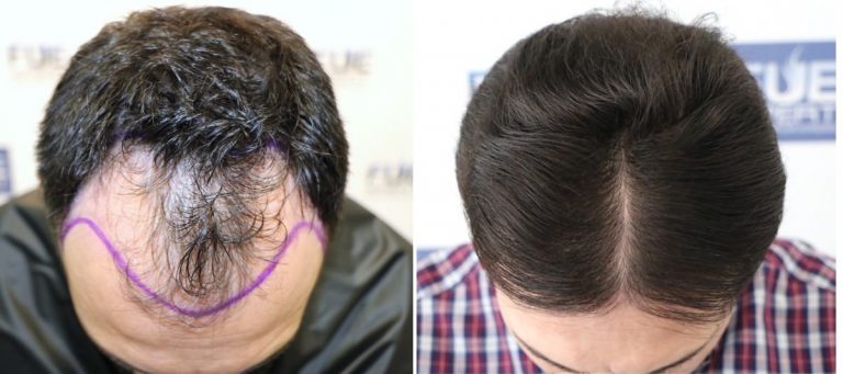 Antes y Después 3343 Injertos- Trasplante capilar FUE - Dr Juan Couto en clínica capilar FUExpert Clinic - Madrid, España