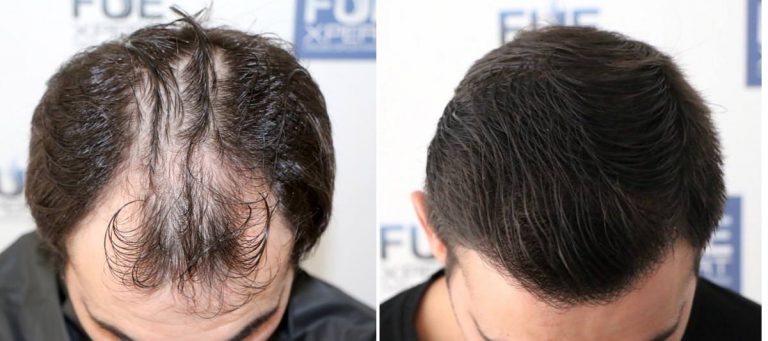 Antes y Después 3500 Injertos- Trasplante capilar FUE - Dr Juan Couto en clínica capilar FUExpert Clinic - Madrid, España