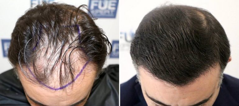 Antes y Después 3500 Injertos- Trasplante capilar FUE - Dr Juan Couto en clínica capilar FUExpert Clinic - Madrid, España