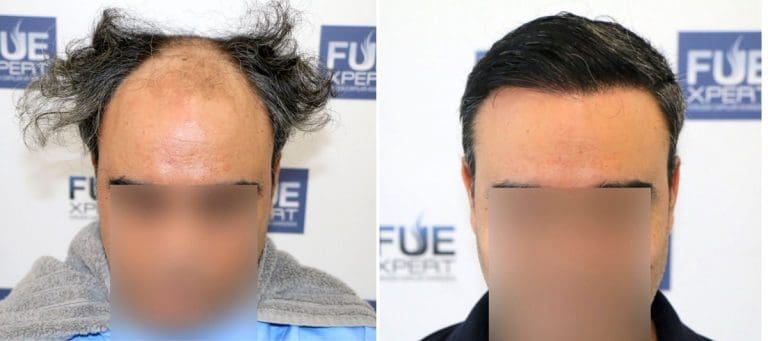 Antes y Después 3500 Injertos- Trasplante capilar FUE - Dr Juan Couto en clínica capilar FUExpert Clinic - Madrid, España