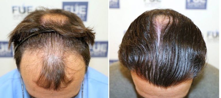 Antes y Después 3544 Injertos- Trasplante capilar FUE - Dr Juan Couto en clínica capilar FUExpert Clinic - Madrid, España