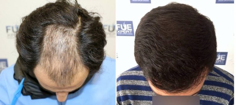 Antes y Después 3640 Injertos- Trasplante capilar FUE - Dr Juan Couto en clínica capilar FUExpert Clinic - Madrid, España