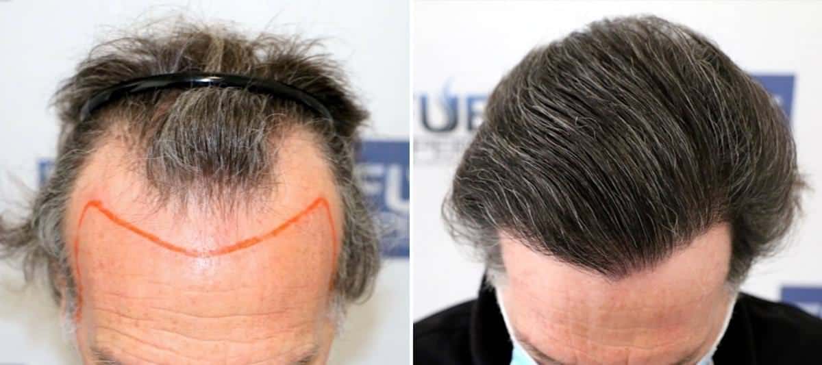 Antes y Después 4225 Injertos- Trasplante capilar FUE - Dr Juan Couto en clínica capilar FUExpert Clinic - Madrid, España