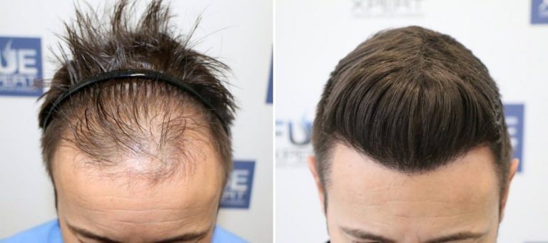 Antes y Después 4275 Injertos- Trasplante capilar FUE - Dr Juan Couto en clínica capilar FUExpert Clinic - Madrid, España