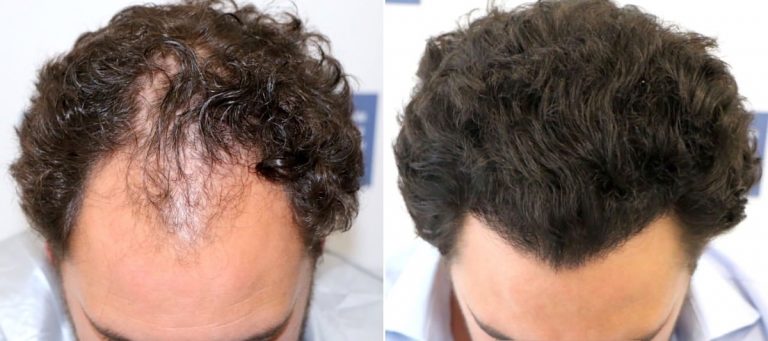Antes y Después 2700 Injertos- Trasplante capilar FUE - Dr Juan Couto en clínica capilar FUExpert Clinic - Madrid, España
