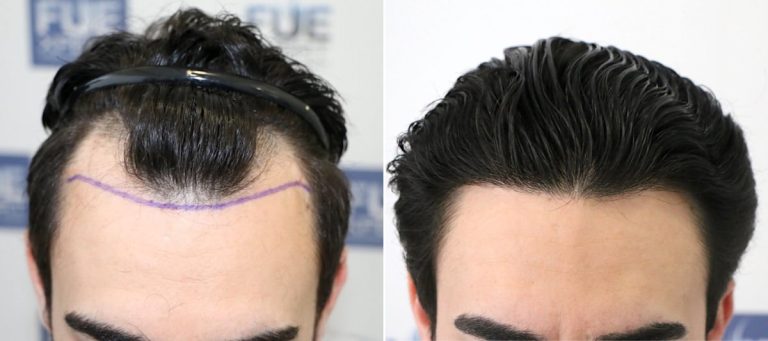 Antes Después - 1531 Injertos - Trasplante capilar FUE - FUExpert Clinic - Dr Juan Couto - Madrid, España 1200px
