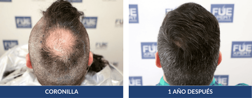 Antes Después Trasplante Capilar 1000 Injertos en Madrid por el Dr Juan Couto en FUExpert Clinic - Mejor Clínica Capilar de Madrid, España y el Mundo