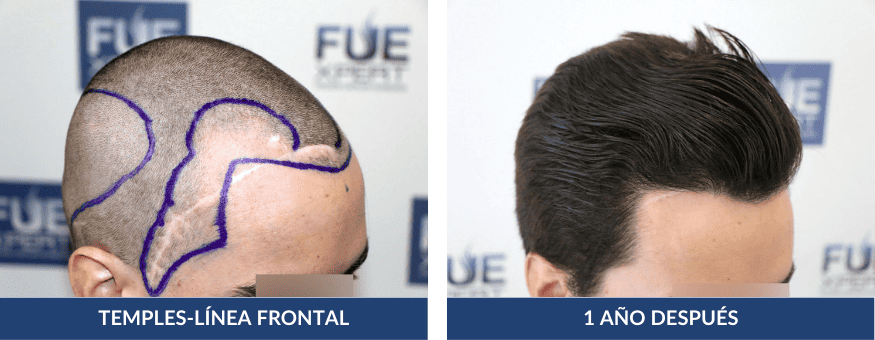Antes Después Trasplante Capilar 2516 Injertos en Madrid por el Dr Juan Couto en FUExpert Clinic - Mejor Clínica Capilar de Madrid, España y el Mundo