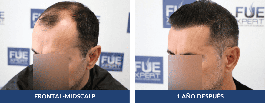 Antes Después Trasplante Capilar 3070 Injertos en Madrid por el Dr Juan Couto en FUExpert Clinic - Mejor Clínica Capilar de Madrid, España y el Mundo