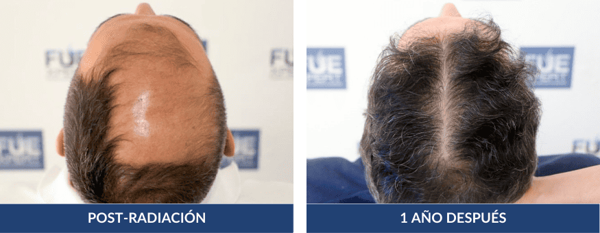 Antes Después Trasplante Capilar 5805 Injertos en Madrid por el Dr Juan Couto en FUExpert Clinic - Mejor Clínica Capilar de Madrid, España y el Mundo