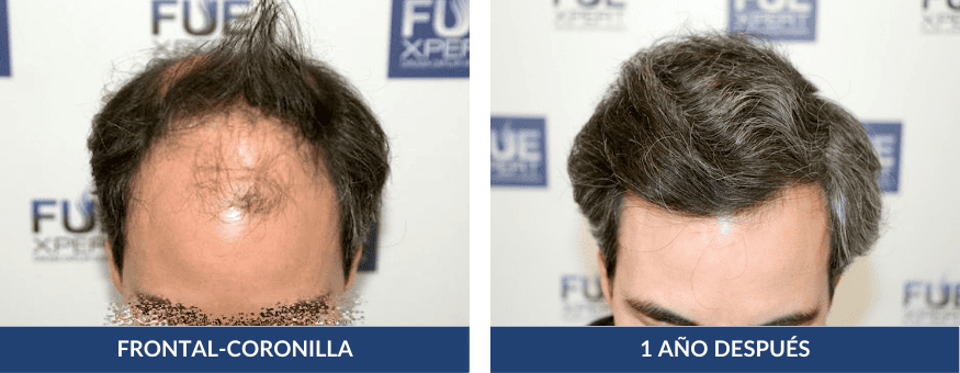 Antes Después Trasplante Capilar 5886 Injertos en Madrid por el Dr Juan Couto en FUExpert Clinic - Mejor Clínica Capilar de Madrid, España y el Mundo