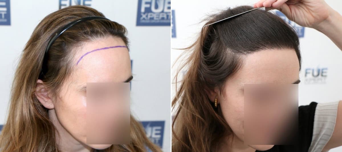 Trasplante-Capilar-2000-Injertos-para-reduccion-de-frente-sin-cirugia-por-el-Dr-uan-Couto-en-FUExpert-Clinic-Madrid-Espana