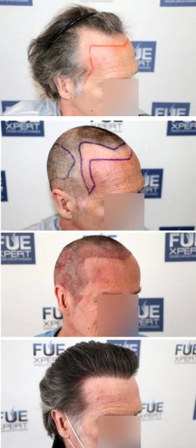 Trasplante-Capilar-temples-y-primera-linea-FUE-4225-Injertos-por-el-Dr-Couto-en-FUExpert-Clinic-Madrid-clinica-capilar-en-Madrid-Espana