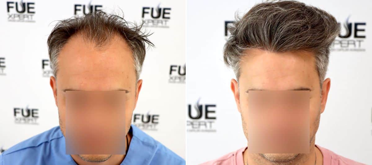 Caso 2, antes y después de injerto de primera línea y zona media
